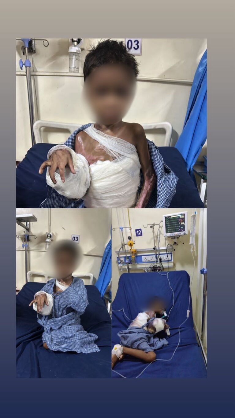 कमल की मुस्कान लौटी: मीतान फाउंडेशन ने झुलसे मासूम को दी नई ज़िंदगी