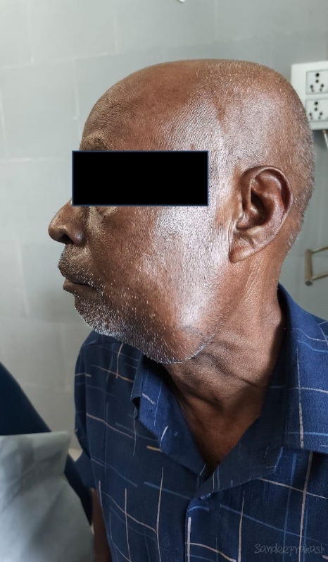 कैंसर के चौथे स्टेज पर था बुजुर्ग, सिम्स के चिकित्सकों ने दिया नया जीवन